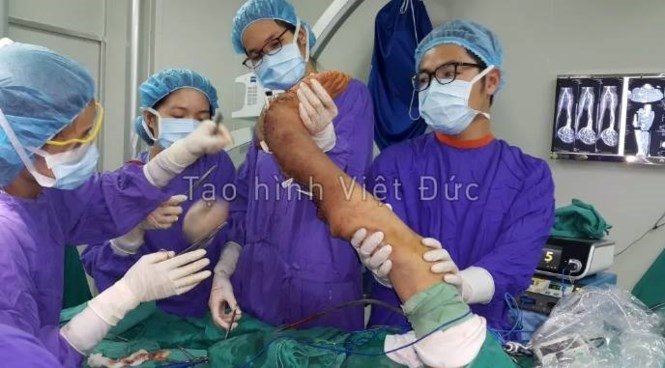 “Giải cứu” cho bệnh nhân mang khối u khổng lồ gần 40 năm - ảnh 3