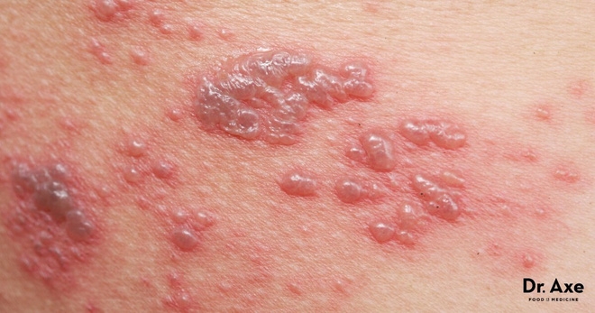 7 nguyên nhân dẫn đến bệnh Lichen phẳng - căn bệnh viêm da không có cách điều trị - Ảnh 2.