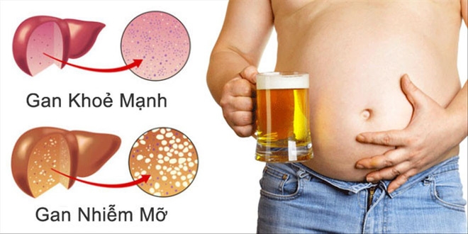 Sức khoẻ gan rất quan trọng: 6 dấu hiệu bệnh gan nhiễm mỡ bạn cần biết để phát hiện ngay - Ảnh 1.