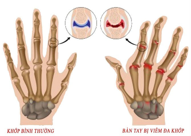 viêm khớp, viêm khớp dạng thấp, Bệnh viện Đại học Y dược TP.HCM