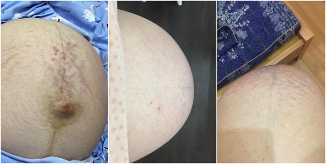Mẹ 9x kể về hành trình mang thai ba: Quyết định giữ lại cả ba con dù bác sĩ nào cũng khuyên bỏ bớt - Ảnh 3.