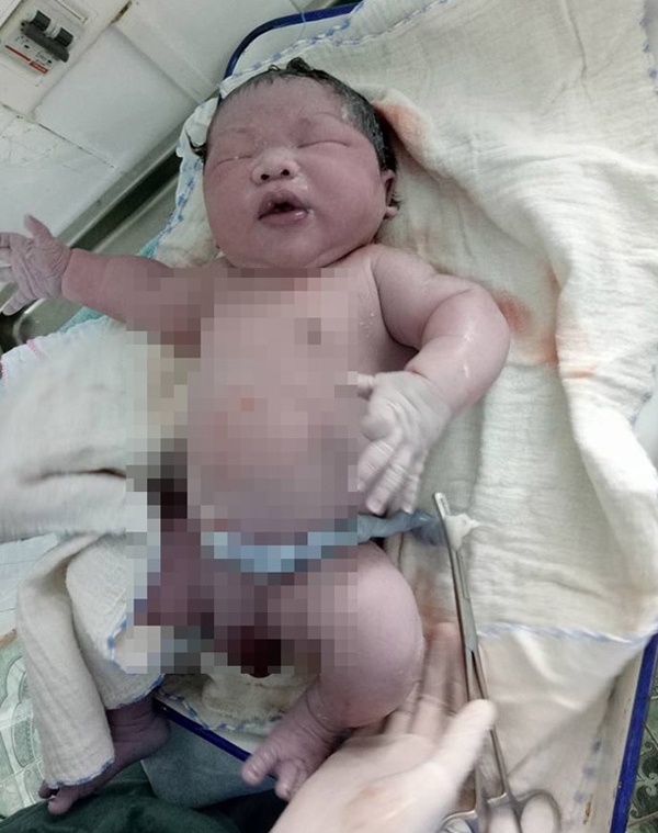 sơ sinh, sinh mổ, Vĩnh Phúc
