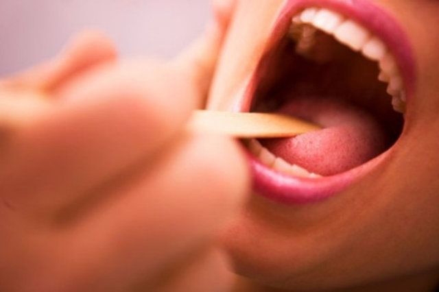 Dấu hiệu của viêm amidan bạn nhất định không được bỏ qua, tránh biến chứng nguy hiểm - Ảnh 3.