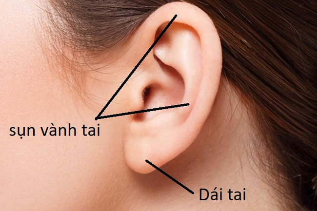 Hình ảnh sẹo đùn kín tai 'do nâng mũi bằng sụn tai' gây sốc trên MXH: Có hay không việc sửa mũi đẹp xong khiến tai bị dị dạng? - 3