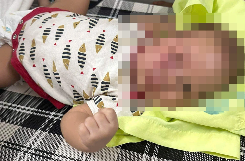 Công an vào cuộc vụ cháu bé 3 tháng tuổi bị đánh bầm tím mặt