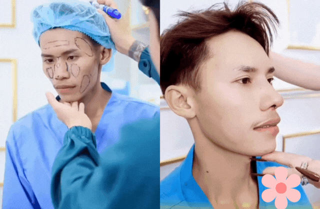 Chàng trai hot nhất Nam vương Campuchia đạt kết quả không tưởng sau 2 tháng sửa hết mặt tại Việt Nam - 3 Chàng trai hot nhất Nam vương Campuchia đạt kết quả không tưởng sau 2 tháng sửa hết mặt tại Việt Nam - 3